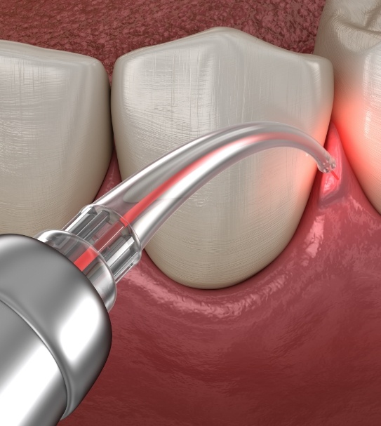 Animated smile during laser gum disease treatment