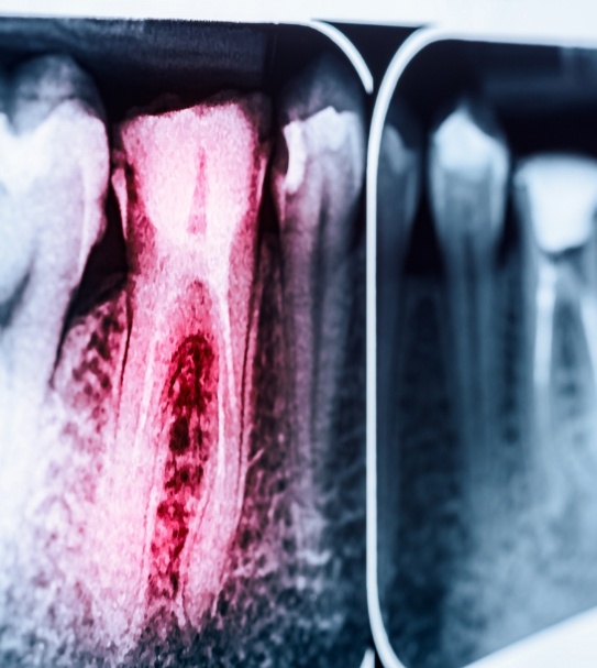 X ray of tooth in need of root canal treatment