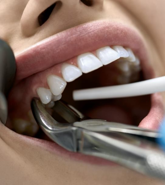 Closeup of mouth during tooth extraction