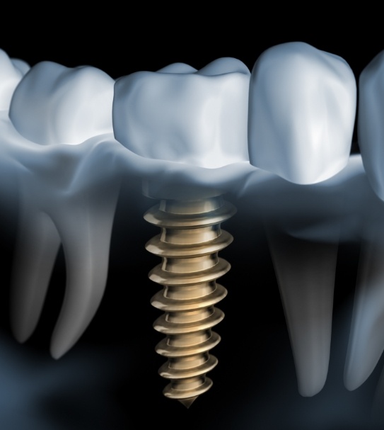 Animated smile with dental implant supported dental crown