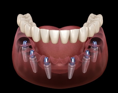 Animated smile during dental implant denture placement
