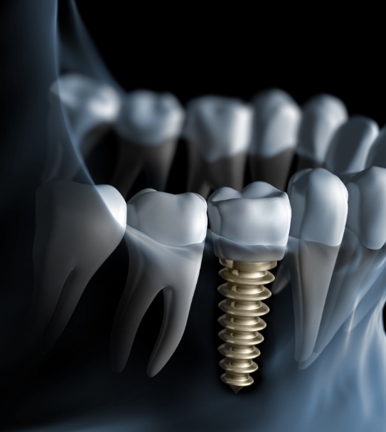 Animated dental implant supported replacement tooth