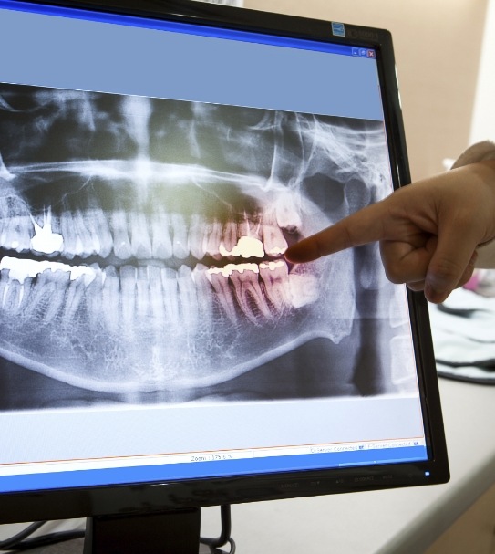 Finger pointing to digital dental x rays